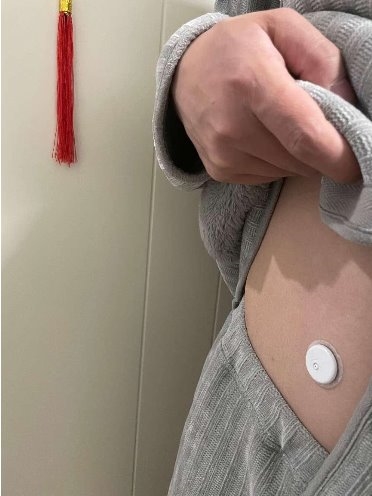 动态血糖仪准确吗？家有肉肉娃，降糖减重需兼顾