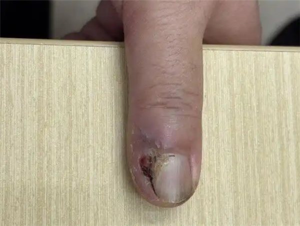 指甲长出怪东西 医生切开后倒吸凉气：癌里的大BOSS
