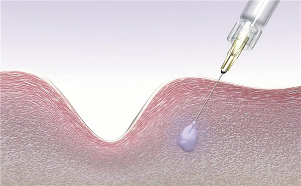 新型避孕针问世：一针管两年 可自行注射