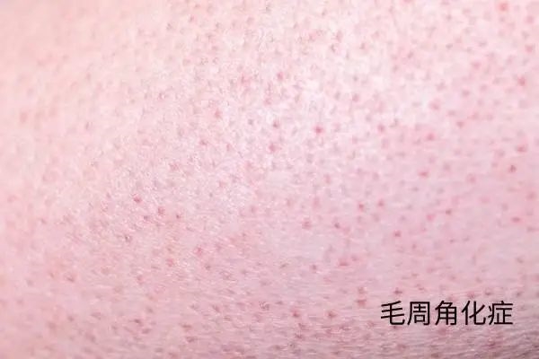 几块钱一管的维A酸乳膏:是护肤圣品 还是致癌毒物
