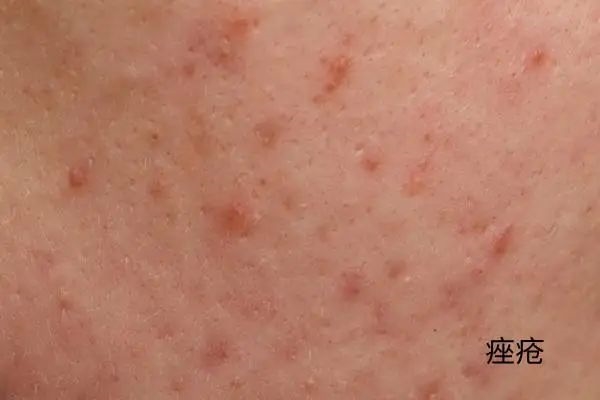 几块钱一管的维A酸乳膏:是护肤圣品 还是致癌毒物