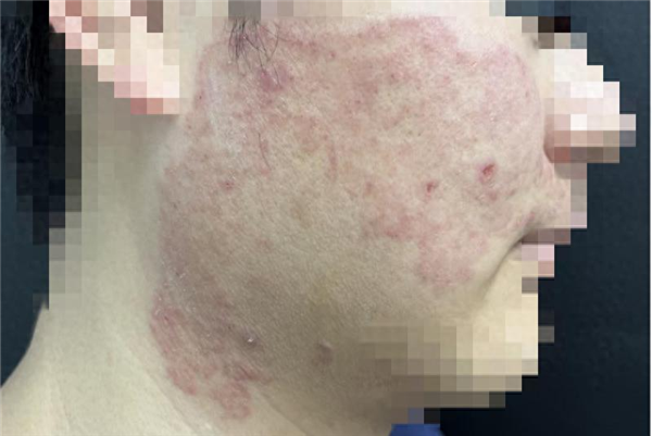 宁波小伙拿擦脚巾擦脸 结果脚气上脸！专家：有人闻臭袜肺部感染