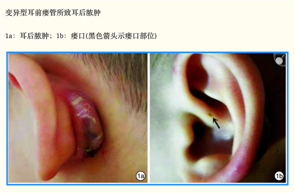 可怕！耳朵上的这个小洞 可能是个不定时炸弹