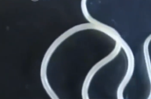 11岁男孩感染寄生虫瘦到15公斤：治疗排出一条13厘米长蛔虫