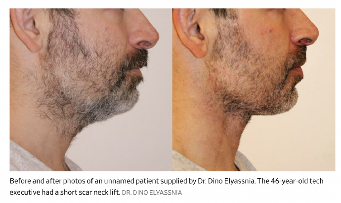 为了不被裁员硅谷科技男扎堆做医美，5 年手术量暴增5倍，背后藏着30岁裁员魔咒